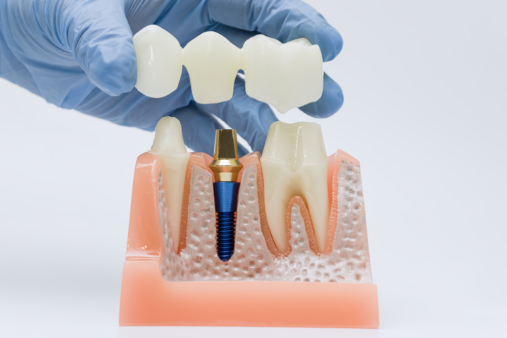 Restorative Dentistry Dr. Maria Smith restorative dentistry showing a dental bridge and implant model for expert tooth replacement in Shelton.