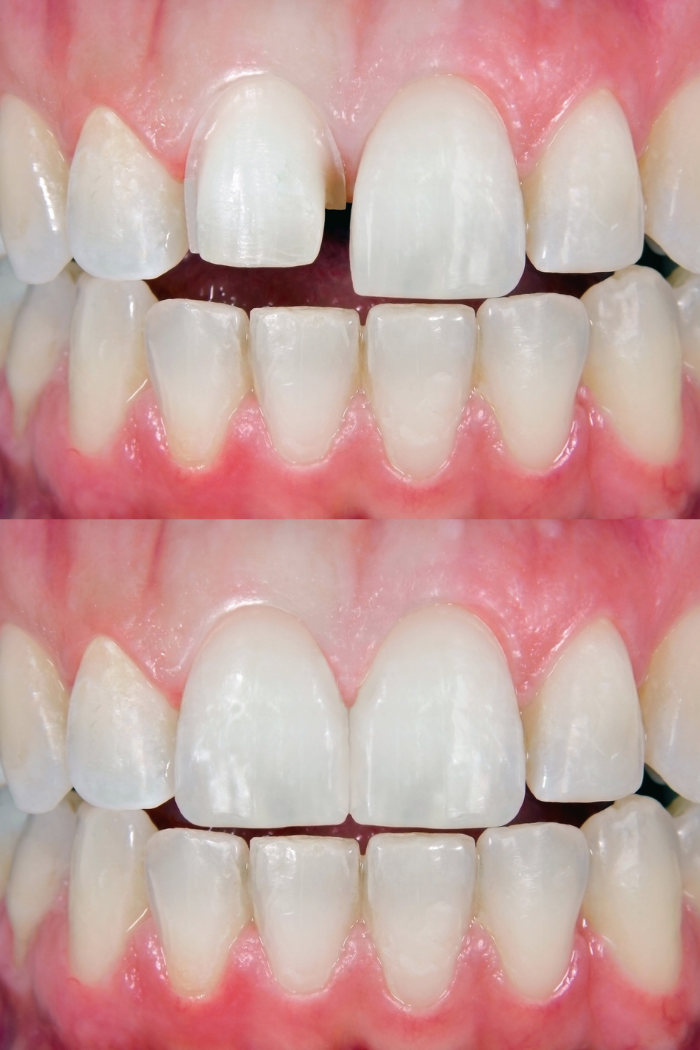 A detailed before and after comparison of a patient’s central incisors, showing the correction of a chip, uneven length, and a gap using seamless, custom-matched porcelain veneers.