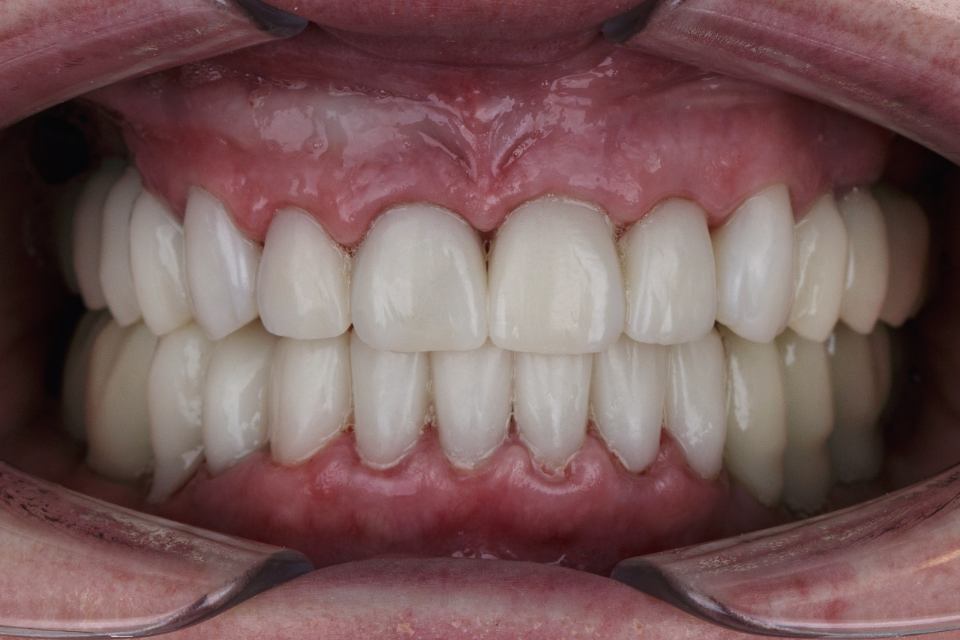 Close-up of natural-looking bonded restorations on front teeth by Dr. Maria A. Smith in Shelton CT.