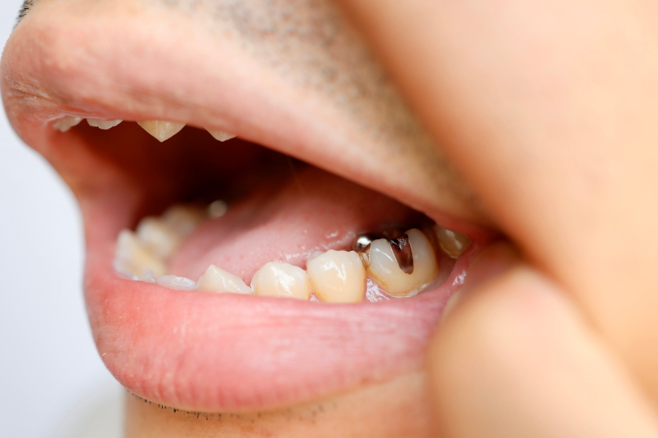 Detailed view of a custom porcelain inlay being prepared to restore a damaged molar tooth.