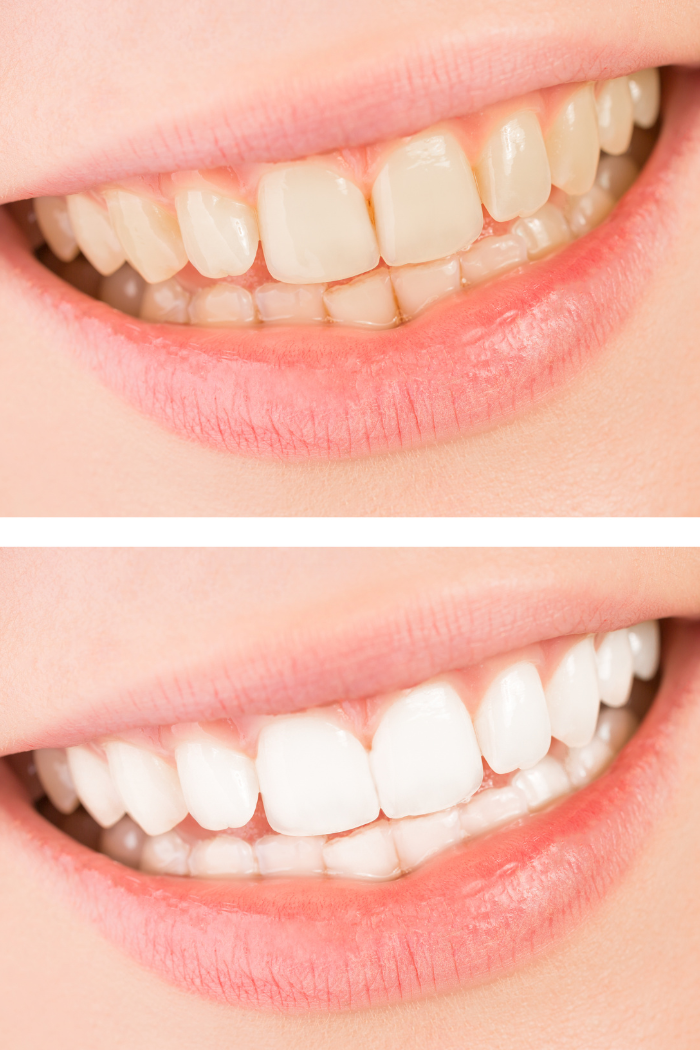 Before and after comparison of a patient’s smile showing the transition from yellowed, uneven teeth to bright, white, and perfectly aligned teeth through dental bonding in Shelton, CT.