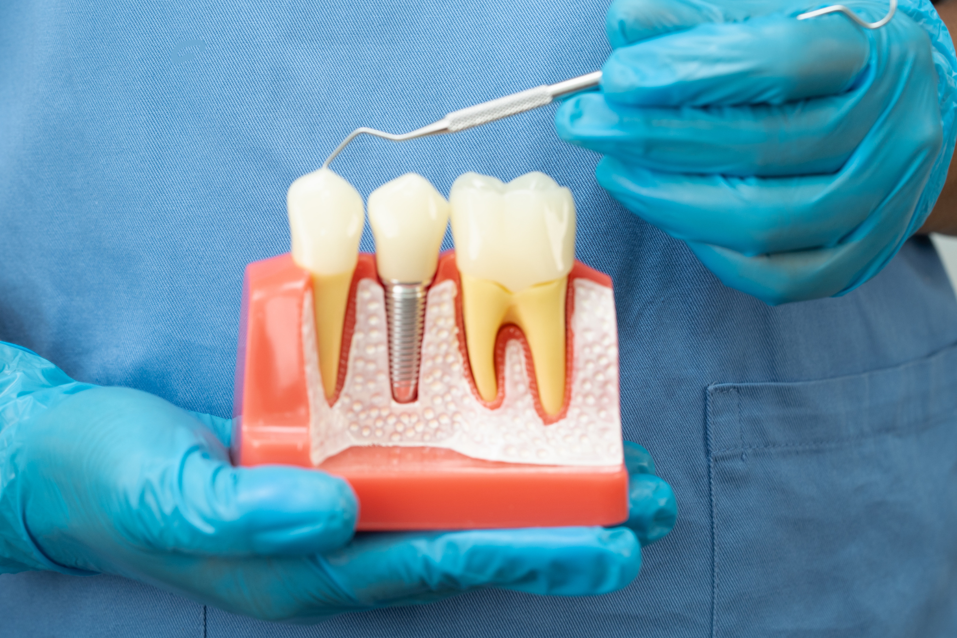 A cross-section dental model being held by an expert, illustrating how a titanium dental implant integrates into the jawbone to support a custom porcelain crown in Shelton, CT.