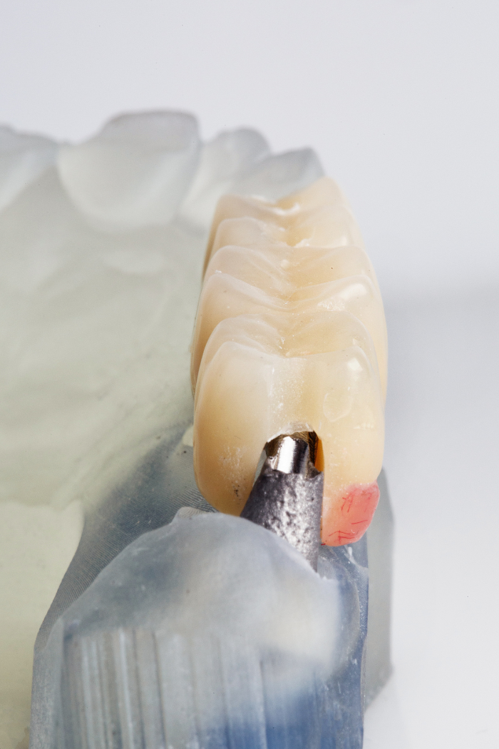 A high-precision fixed dental bridge being fitted onto a dental model, showcasing the anatomical detail and custom engineering of restorative dentistry in Shelton, CT.