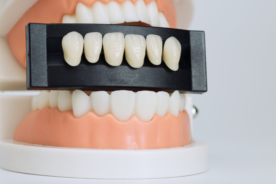 A dental study model featuring a specialized shade-matching fixture holding six varied porcelain veneer samples against the patient's existing teeth to determine the optimal color and translucency.