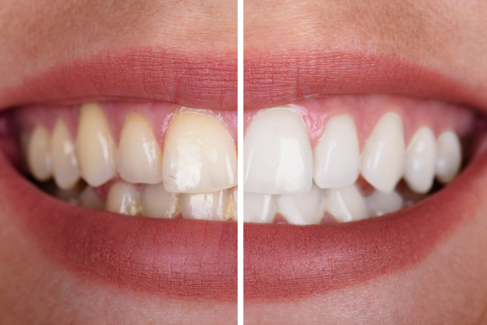 Side-by-side comparison of stained teeth versus brilliant white teeth after professional dental whitening treatment.